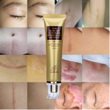 Acne Scar Removal Cream