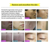 Acne Scar Removal Cream