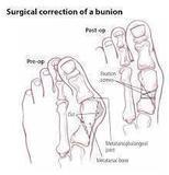 The Bunion Relief and Forefoot Protector Brace "Pair"